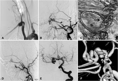 Cerebrovascular disorders associated with agenesis of the internal carotid artery: Findings on digital subtraction angiography